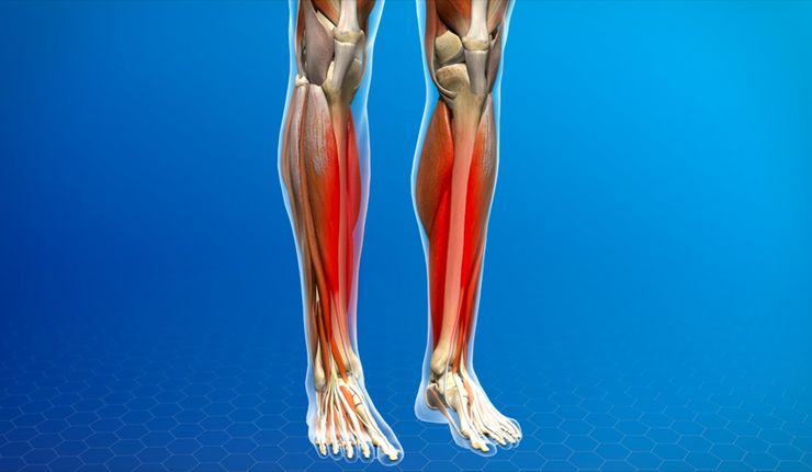 Shin Splints The Irish Dancers Nightmare